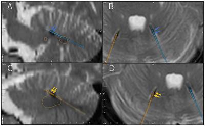 Case Report: Deep Cerebellar Stimulation for Tremor and Dystonia